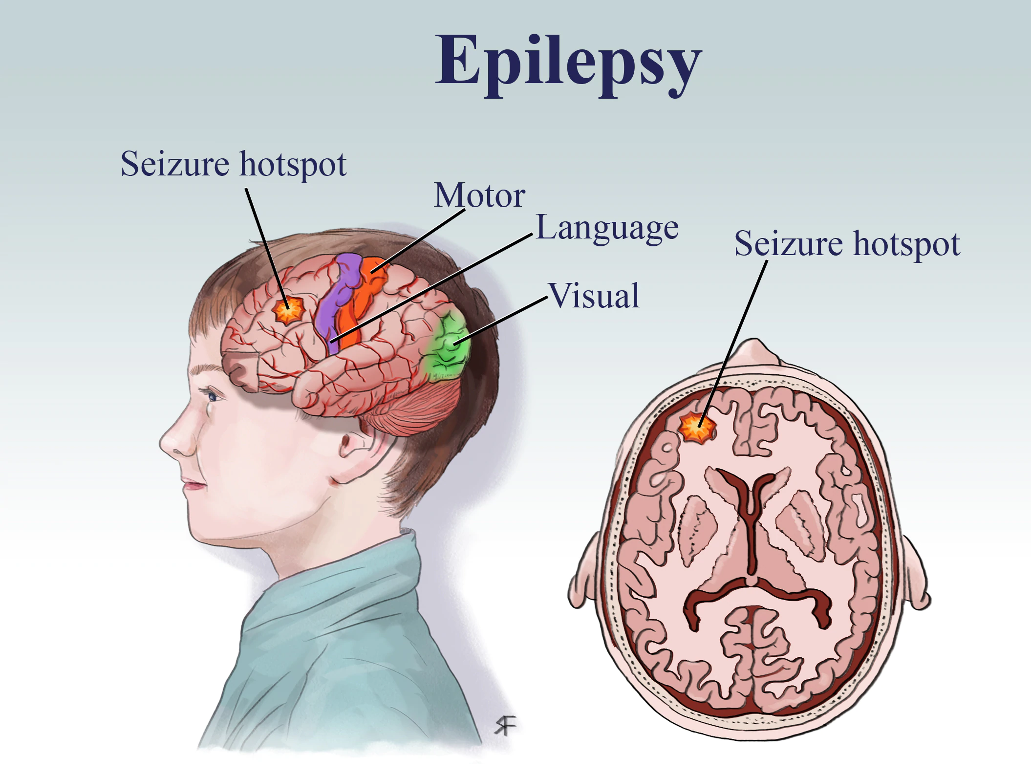 Epilepsy Treatment in Aundh