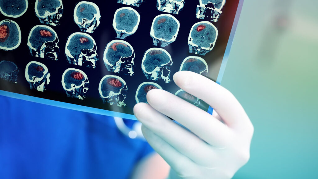 The Role of Neurology in Treating Stroke Patients